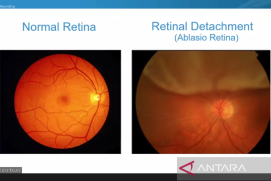Ablasio Retina, Penyakit Mata yang Rentan Serang Individu Usia 40 Tahun ke Atas