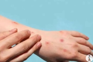 Ciri Khas Ruam Klinis yang Perlu Diwaspadai pada Penderita MPOX